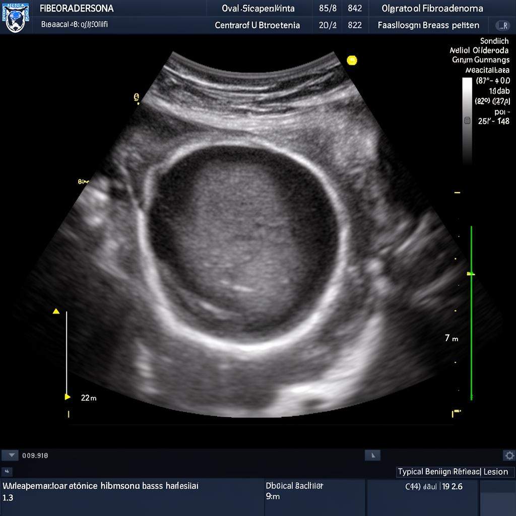 Ultrasound image showing fibroadenoma as a well-defined oval hypoechoic mass in breast tissue